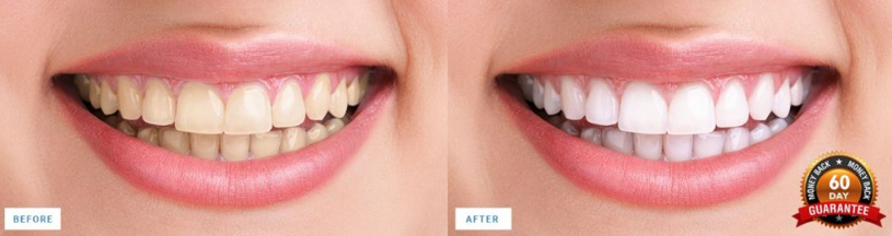 Cleaner Smile Teeth Whitening Kit Before & After Results