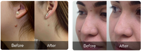 SkinCell Advanced before after