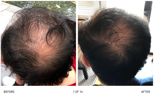 irestore laser before and after