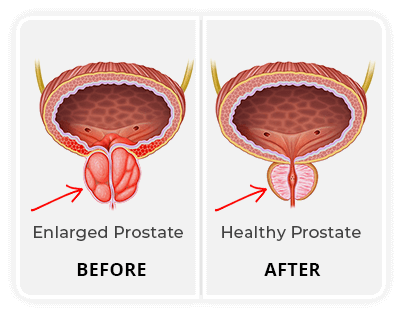 ProstaClear Before & After Results