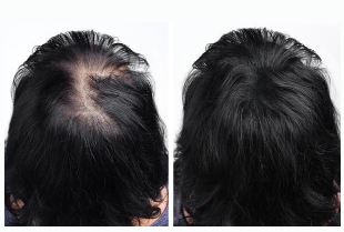 Re-Nourish Hair Growth Before & After Results